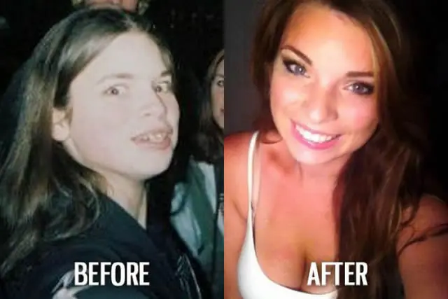 Ugly Duckling Syndrome Before & After (13)