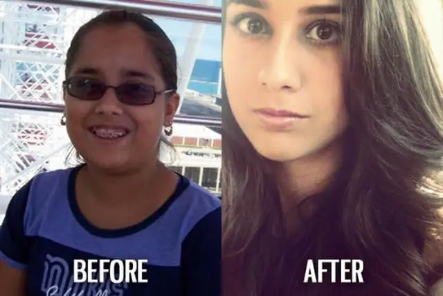 Ugly Duckling Syndrome Before & After (24)