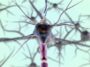 The Graphene Brain Implant That Could Help Parkinson